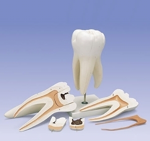 [3B] 6분리 치아모형 D15 실제15배크기 (Giant Molar with Dental Cavities,15 Times Life Size,6-part)